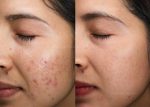 کرم ضد آکنه و ضد جوش Acne دکتر سی تونا فارماسی 50 میلی لیتر
