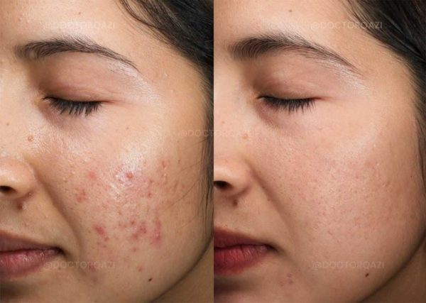 کرم ضد آکنه و ضد جوش Acne دکتر سی تونا فارماسی 50 میلی لیتر