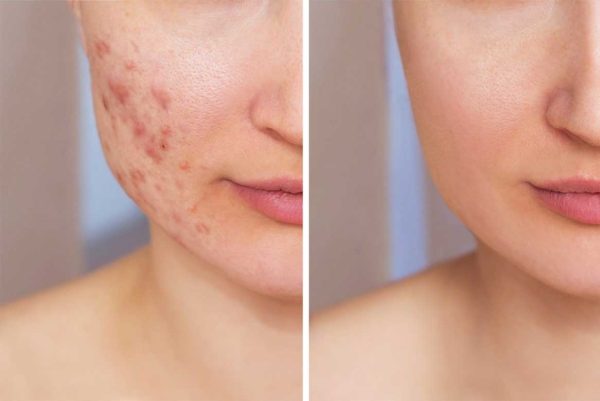 کرم ضد آکنه و ضد جوش Acne دکتر سی تونا فارماسی 50 میلی لیتر